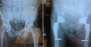 Anterior Hip Replacement