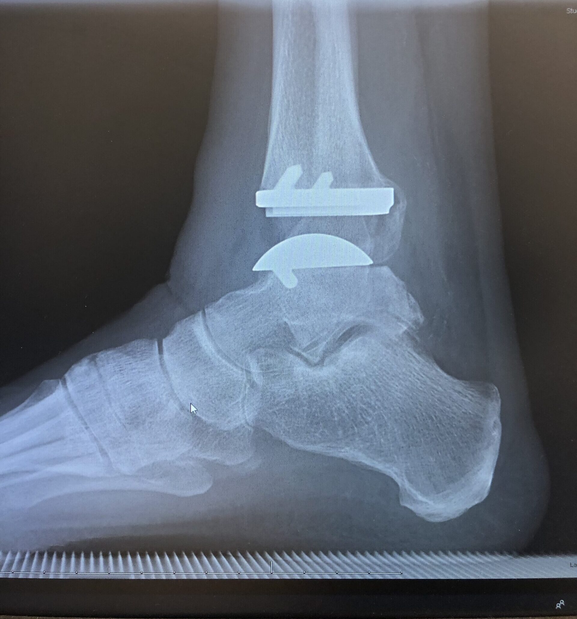 Total Ankle Replacement X Ray